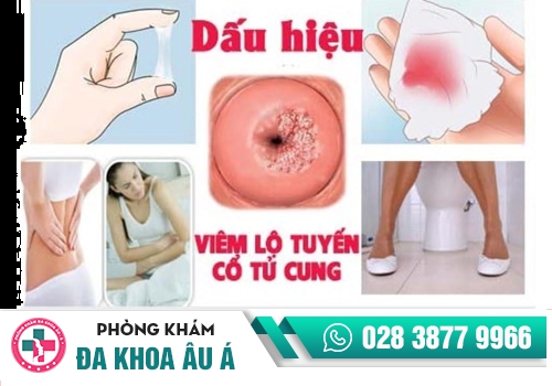 viêm lộ tuyến tử cung